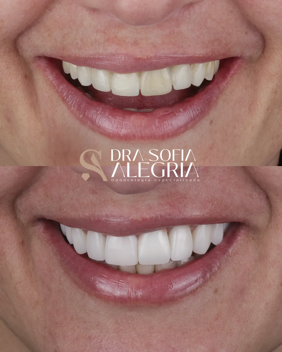 Sonrisa antes y después del tratamiento