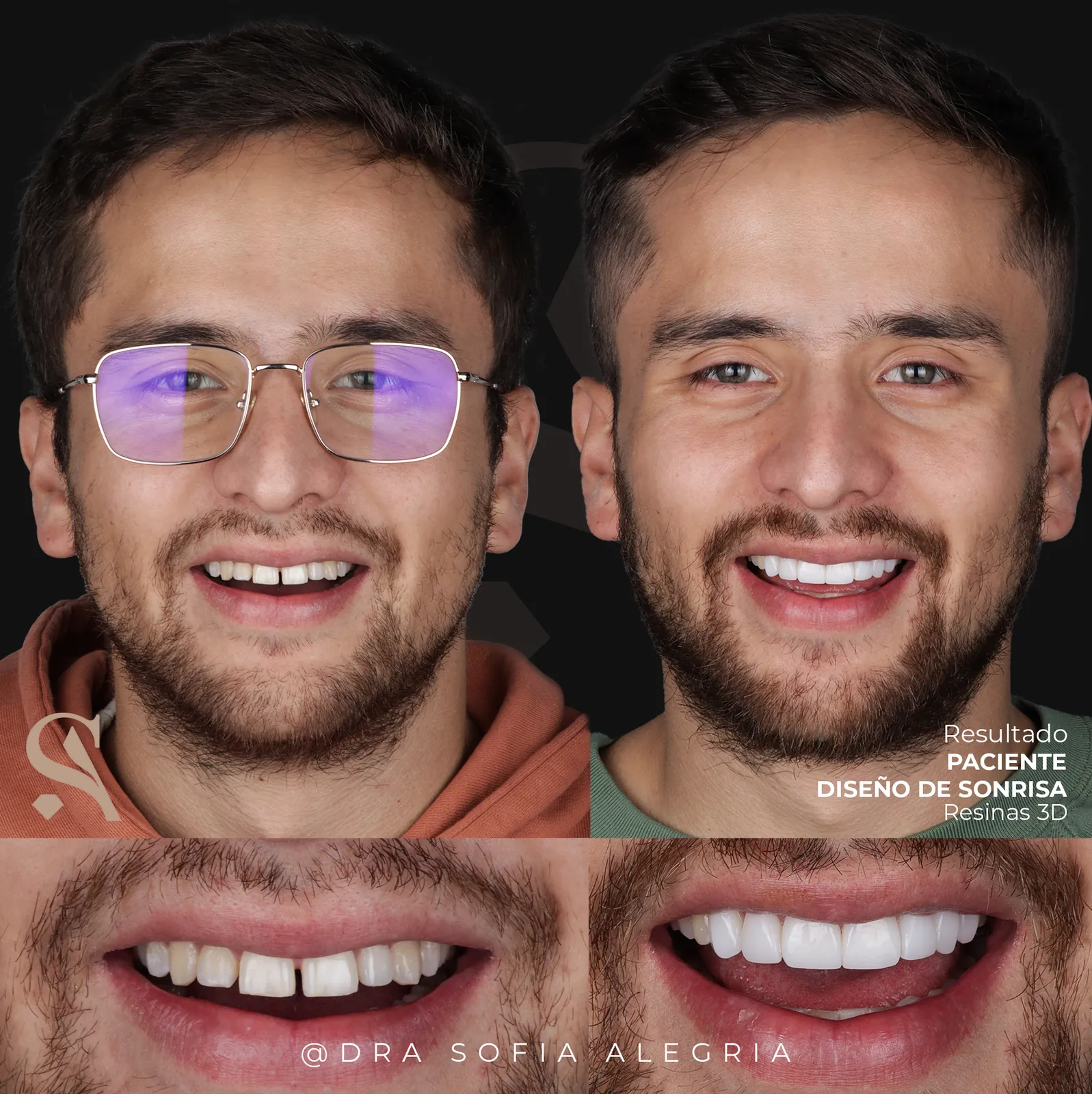 Antes y después de diseño de sonrisa en resinas impresas en 3D