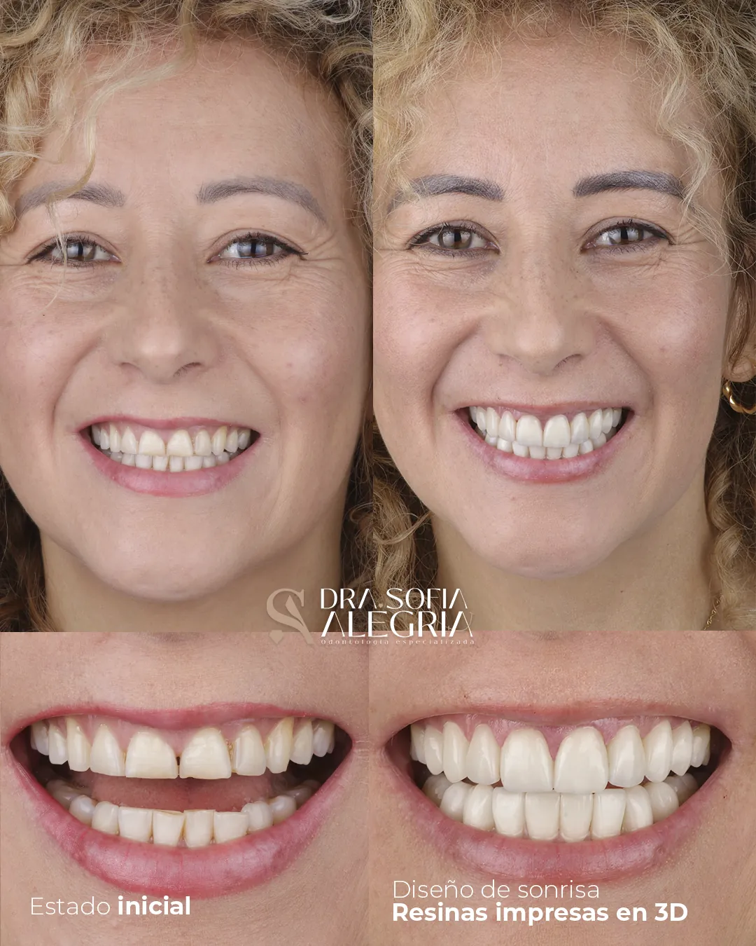 Paciente antes y después de su diseño de sonrisa