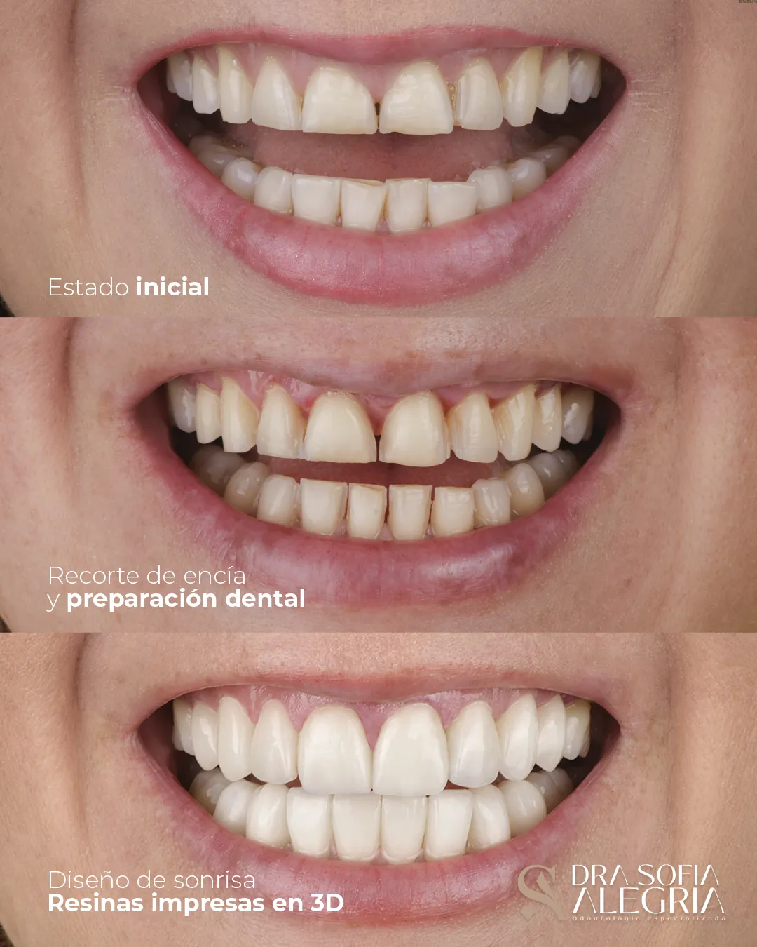 Proceso de diseño de sonrisa: estado inicial, recorte de encía y resultado