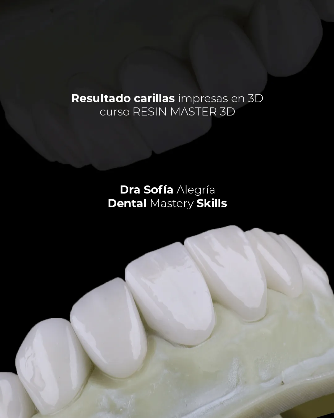 Resultado de carillas impresas en 3D del curso Resin Master 3D