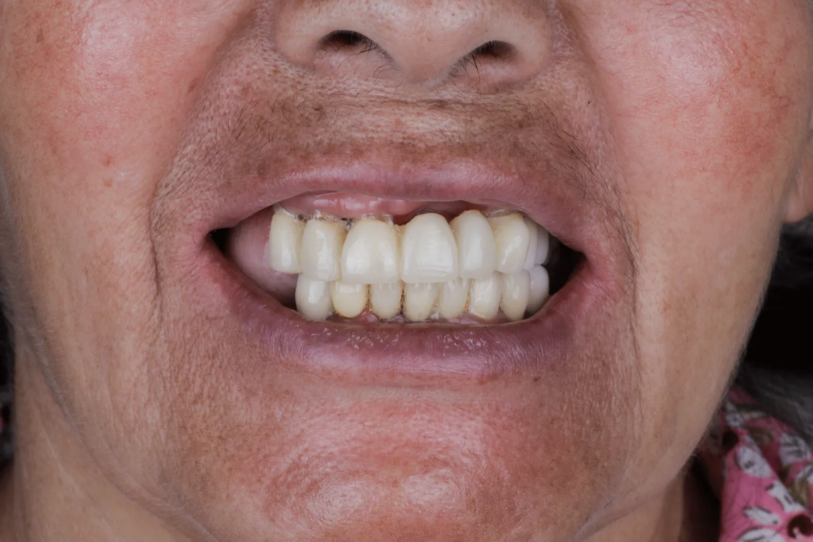 Sonrisa de la paciente antes de su rehabilitación con implantes