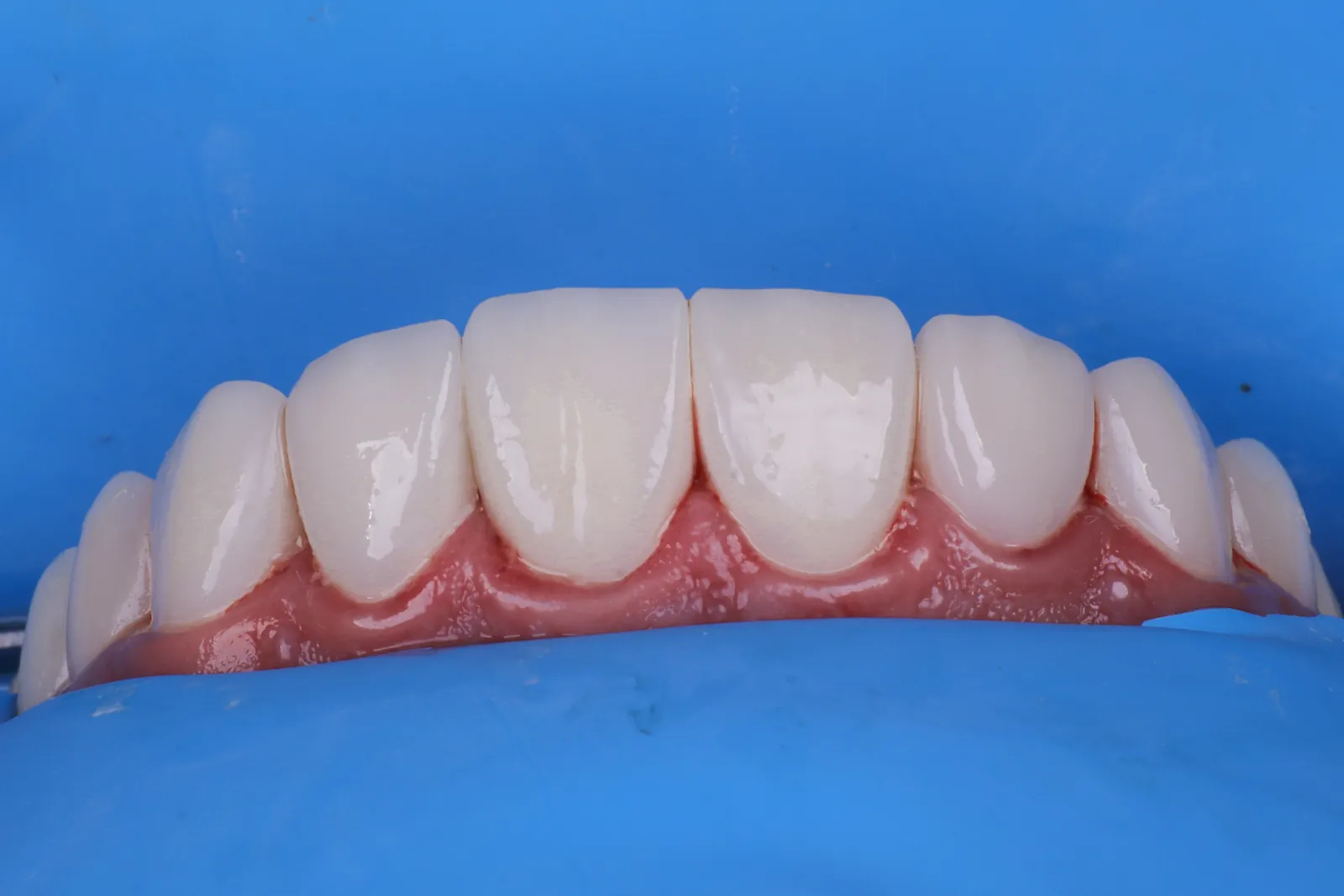 Encía y dientes en armonía sobre modelo